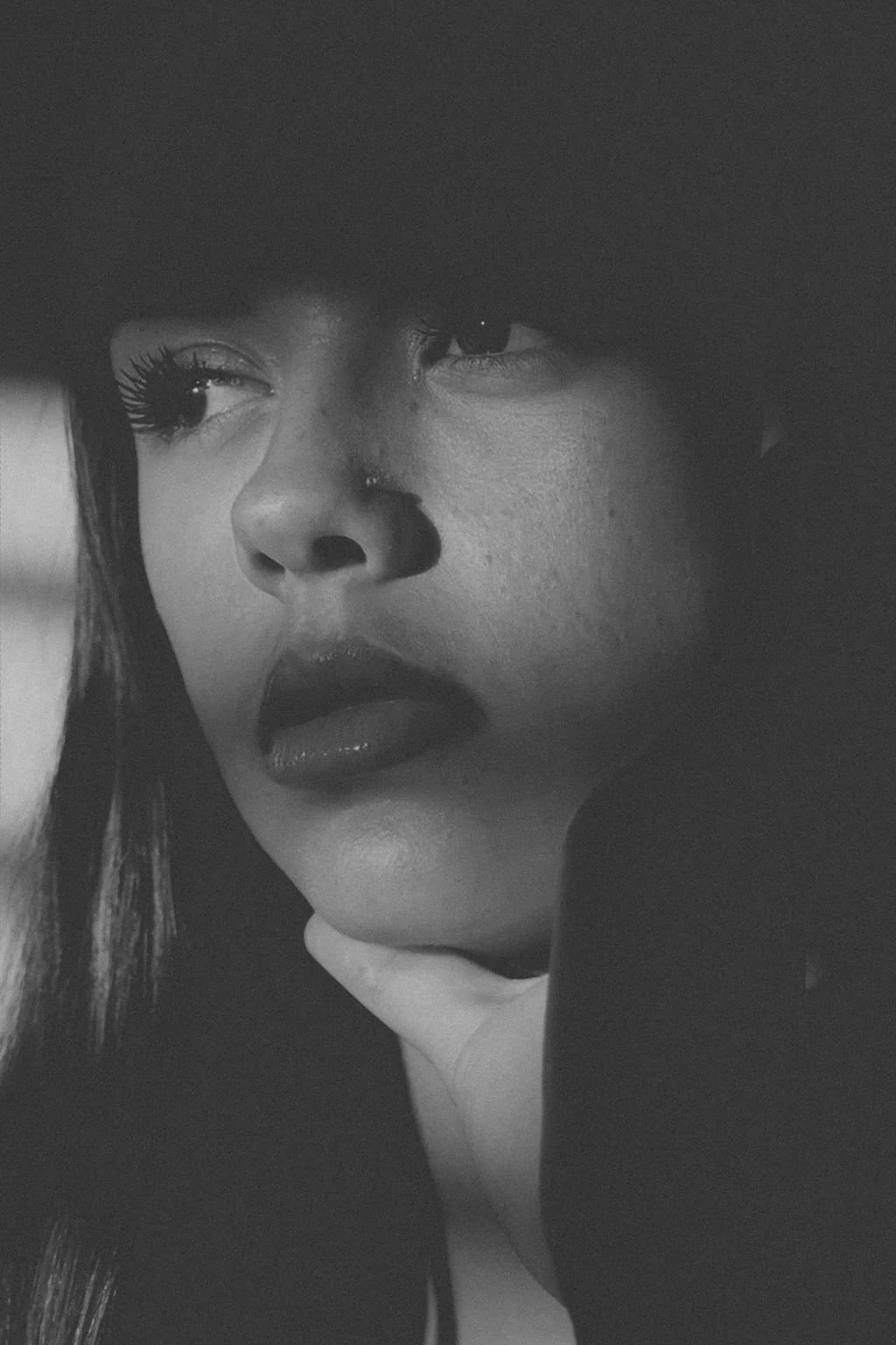 Everything You Need to Know About Dissolving Filler with Hylenex