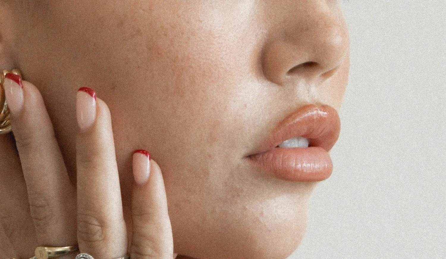 Hylenex Filler Dissolver: How Hyaluronidase Safely Dissolves Dermal Filler