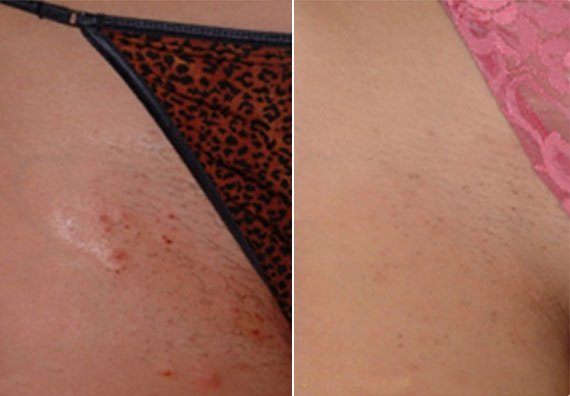 laser-hair-removal-1.jpg