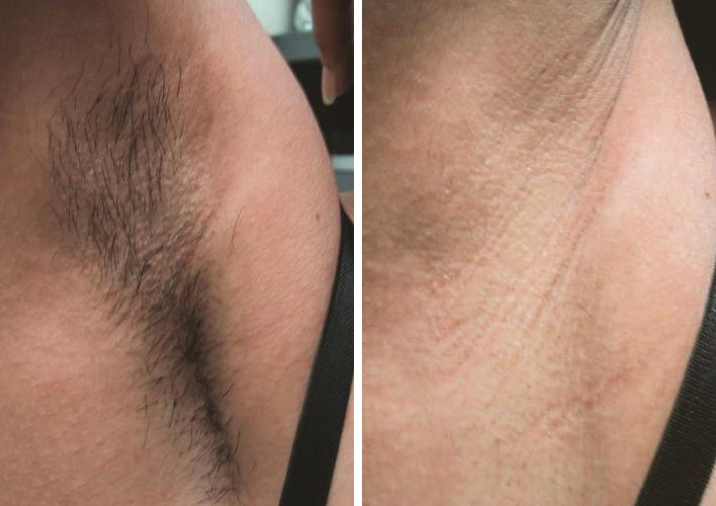 laser-hair-removal-before-and-after-2-scaled.jpg