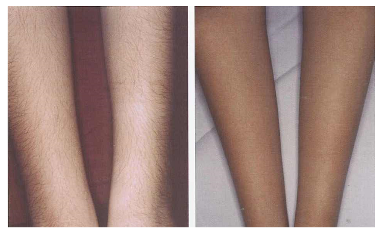 legs-before-after-laser-hair-removal-2.jpg.png