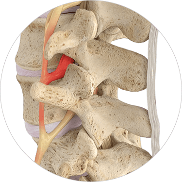 Suffering from Chronic Lower Back Pain? Explore Vertiflex Superion with Dr. John Dombrowski in Washington DC