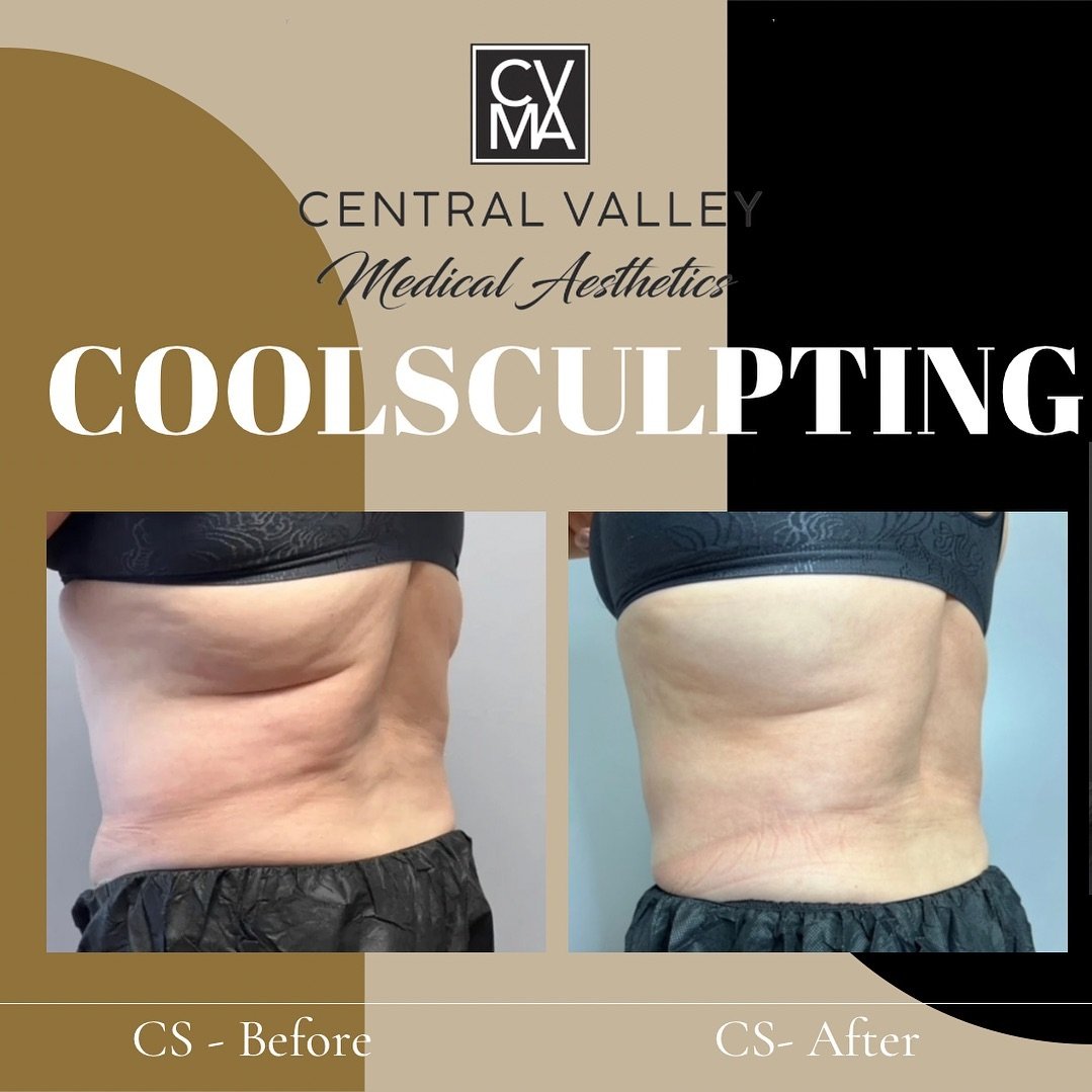 Summer is almost here &amp; ready to tone those stubborn love handles? ☀️ Book your CS session or consultation today!

Call 559-409-2048
Text 559-684-2324
