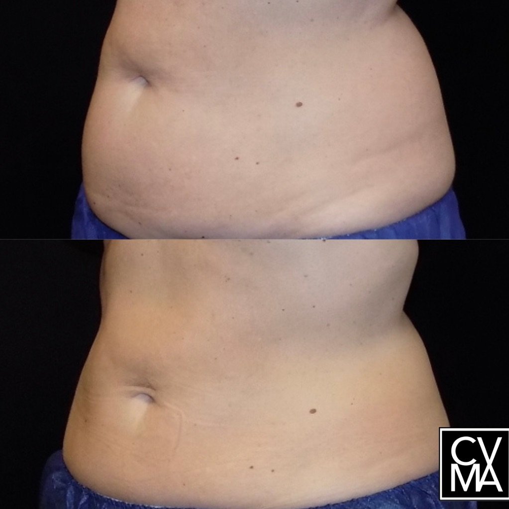 Stubborn fat that won&rsquo;t go away?
Coolsculpting can help with that!
Before and After CS - 8 weeks post session on the lower abdomen.

Coolsculpting paired with Weightloss medication could be the perfect combo for you! CVMA is now offering Semagl
