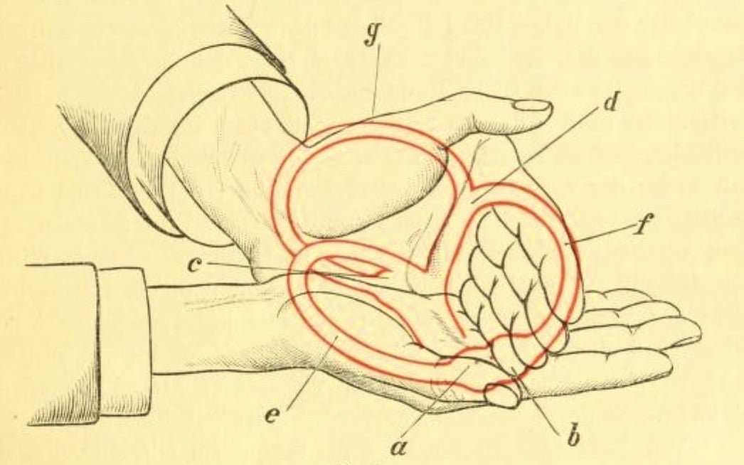 Menière's disease: Symptoms, diagnosis, and the role of vestibular rehabilitation