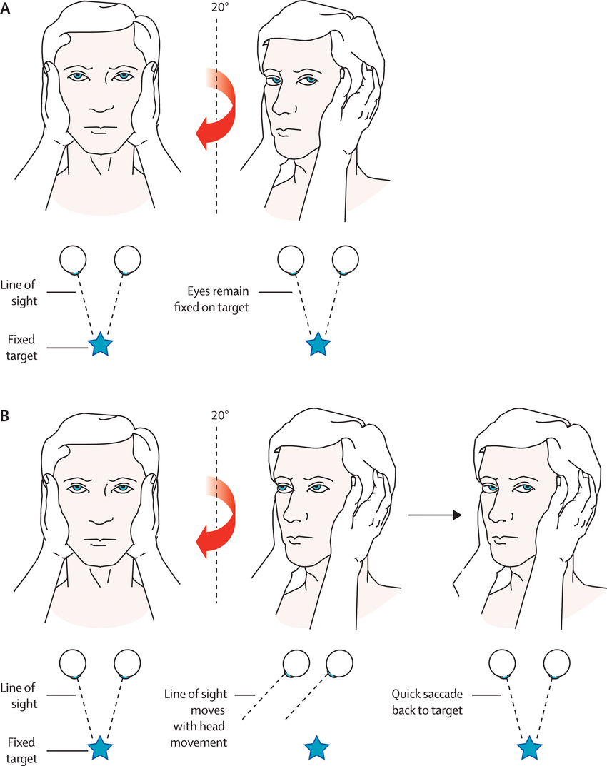 Vestibular Assessment | Vestibular Diagnostic Assessment – VVNBTH