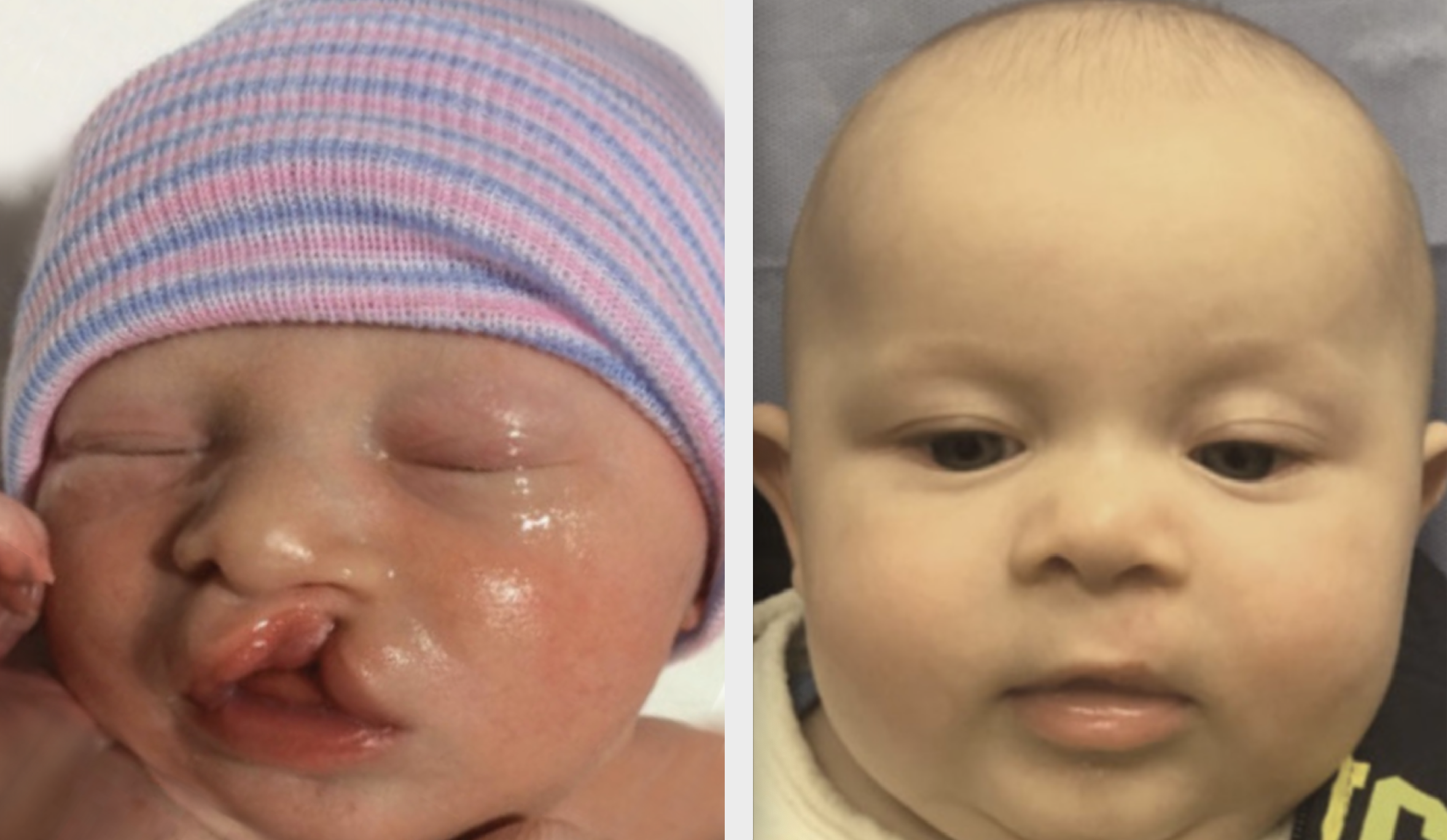 A patient of Dr. Hammoudeh who underwent ECLR at 2 weeks of age, pictured on the right 4 months after surgery.