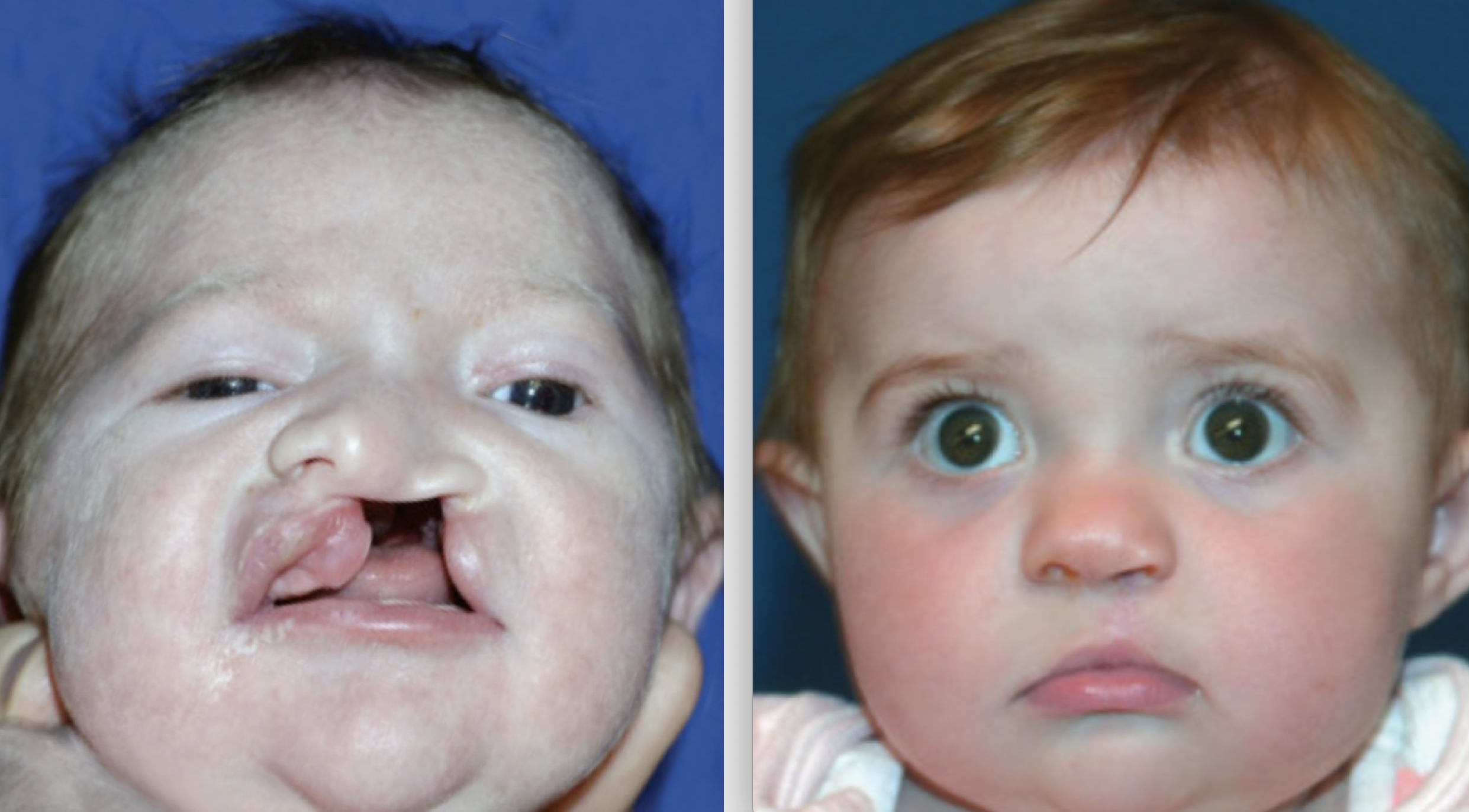 A patient of Dr. Hammoudeh who underwent ECLR at 4 weeks of age, pictured on the right 3 months after surgery.