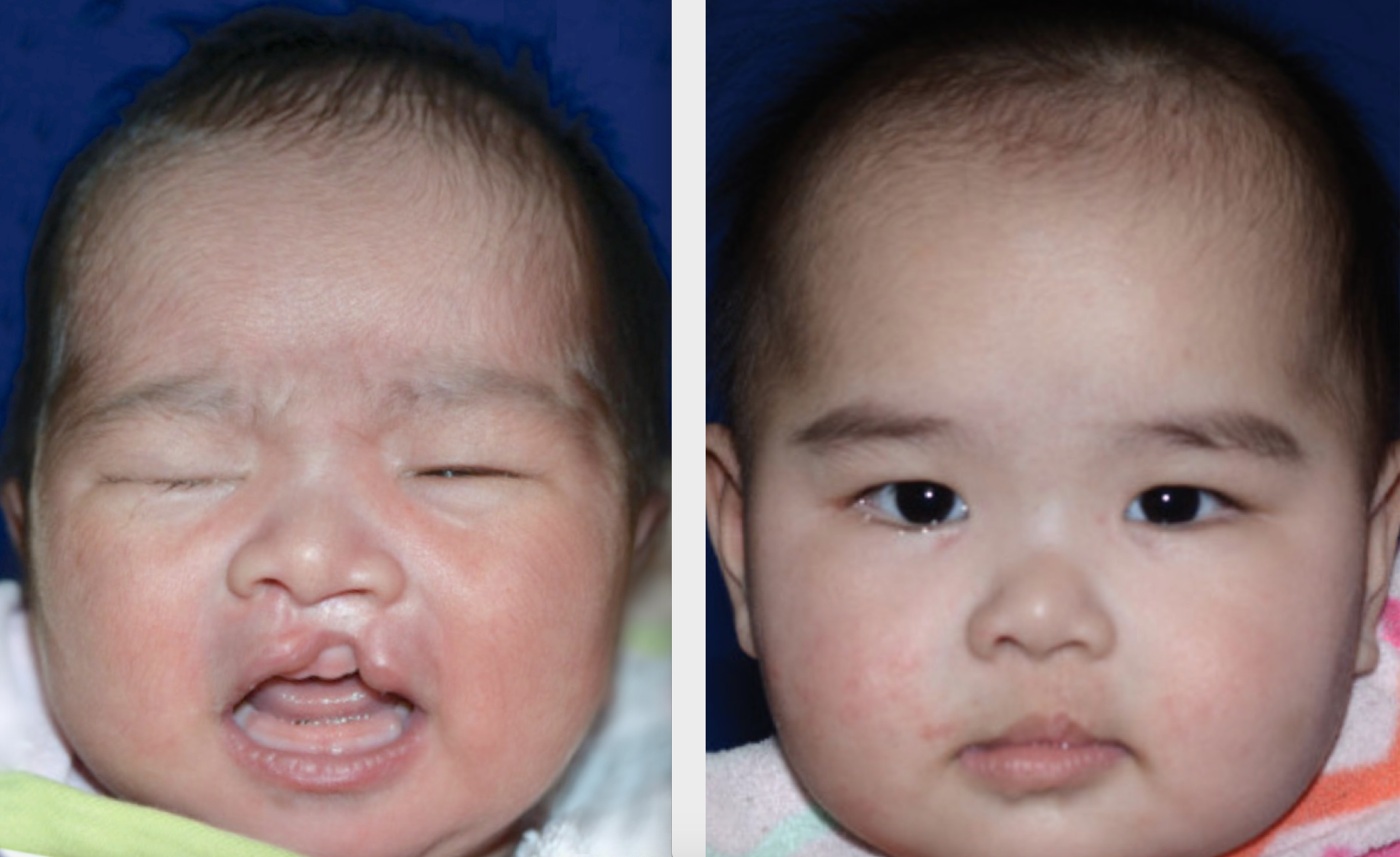 A patient of Dr. Hammoudeh who underwent ECLR at 4 weeks of age, pictured on the right 3 months after surgery.