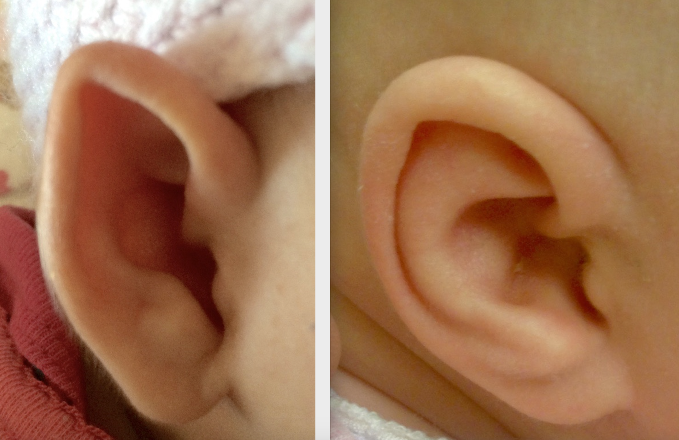 Ear molding restores normal ear shape.