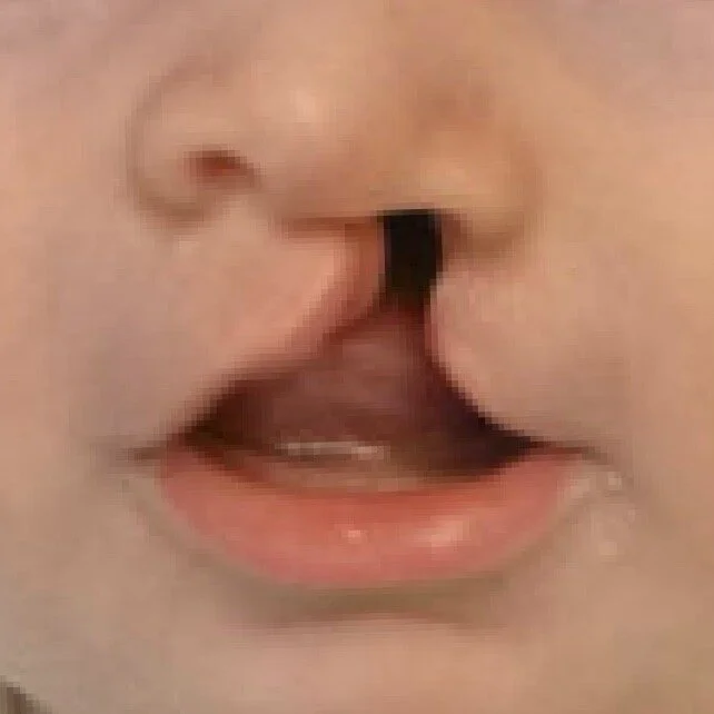 Complete Cleft Lip