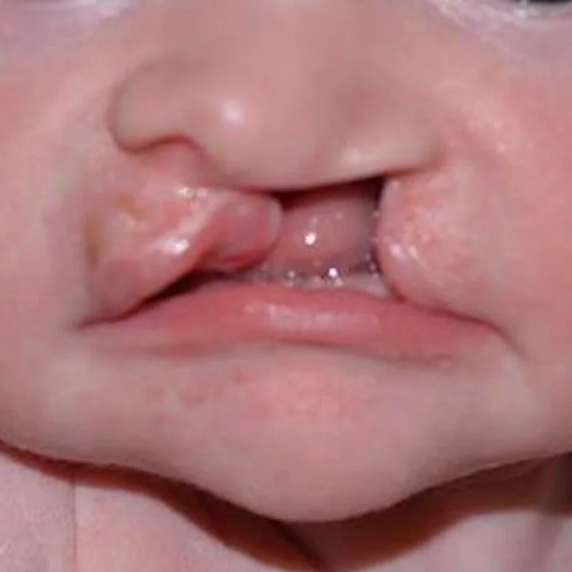 Wide Complete Cleft Lip