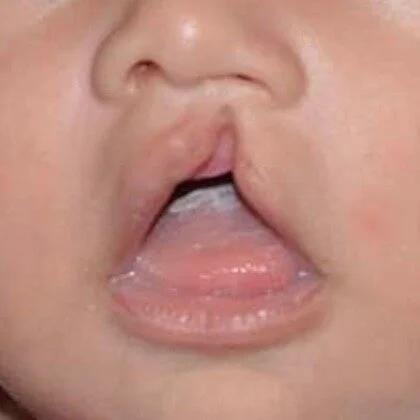 Incomplete Cleft Lip