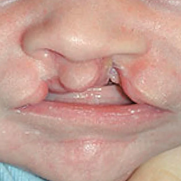 Bilateral Cleft Lip