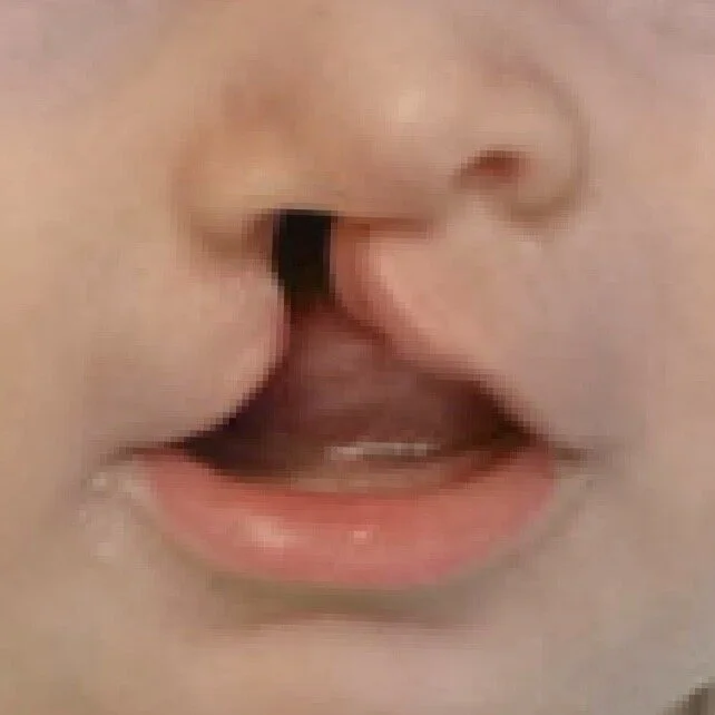 Unilateral (Right-Sided) Cleft Lip