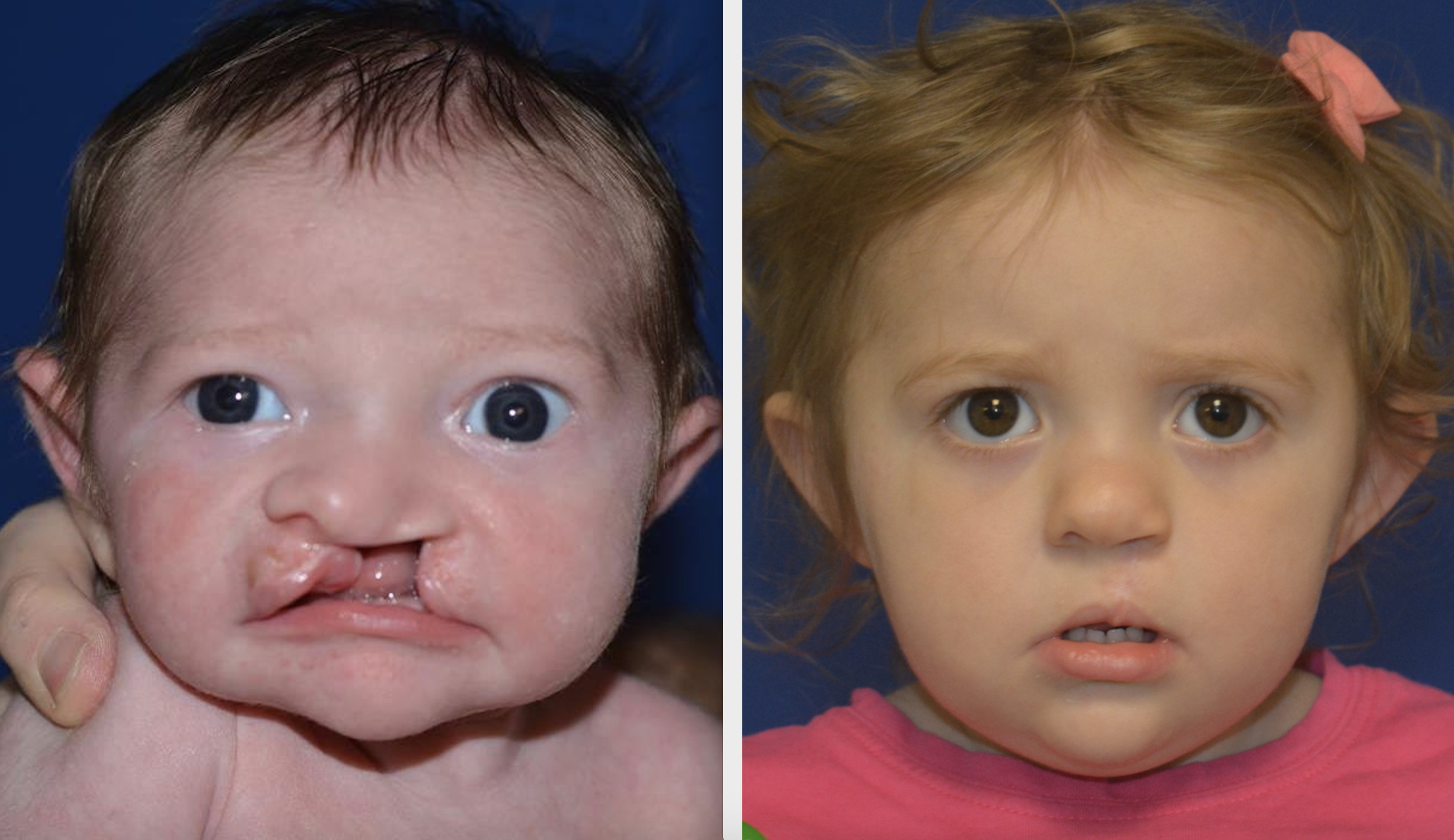 A patient of Dr. Hammoudeh who underwent ECLR at 2 weeks of age, pictured on the right 1 year after surgery.