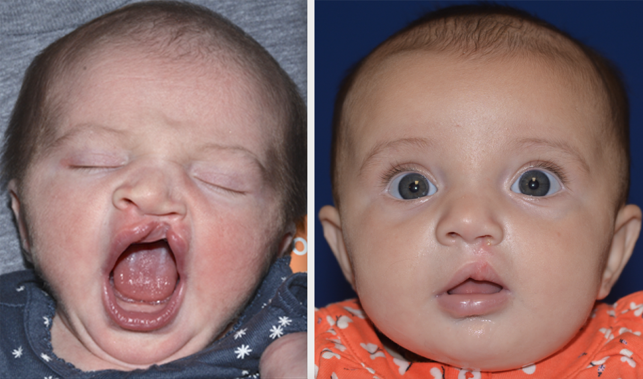 A patient of Dr. Hammoudeh who underwent ECLR at 2 weeks of age, pictured on the right 3 months after surgery.