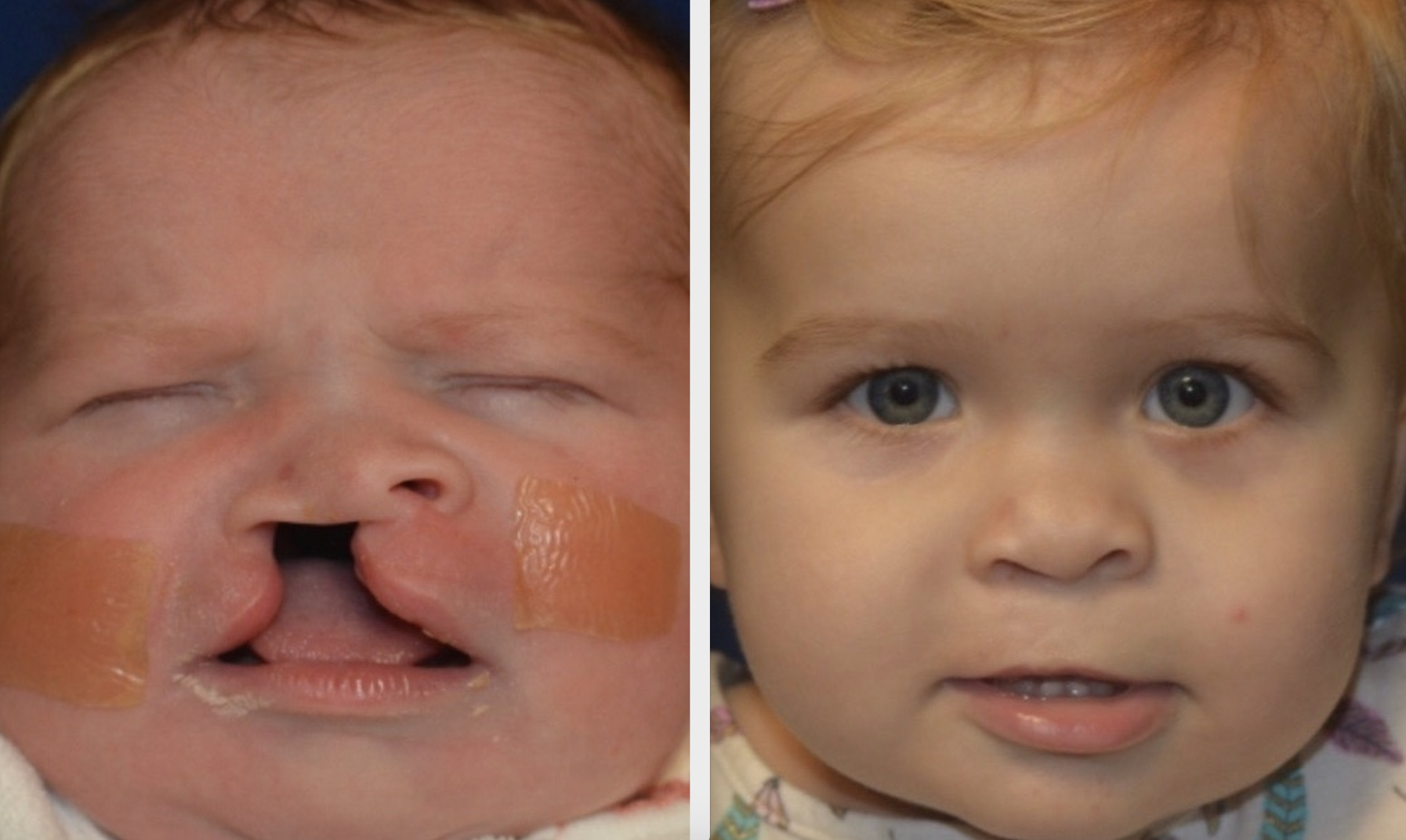 A patient of Dr. Hammoudeh who underwent ECLR at 2 weeks of age, pictured on the right 1 year after surgery.