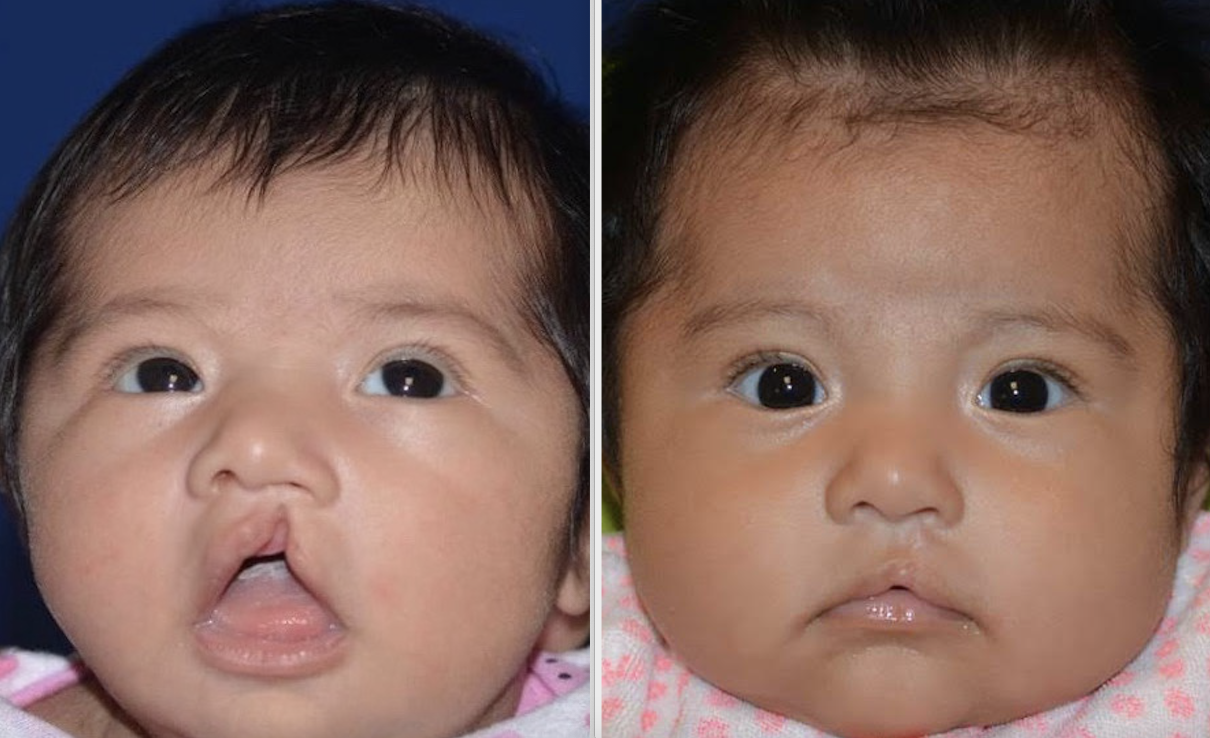 A patient of Dr. Hammoudeh who underwent ECLR at 2 weeks of age, pictured on the right 5 months after surgery.