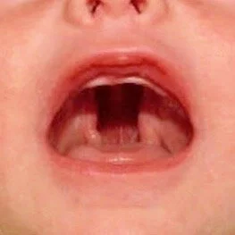 Cleft Palate