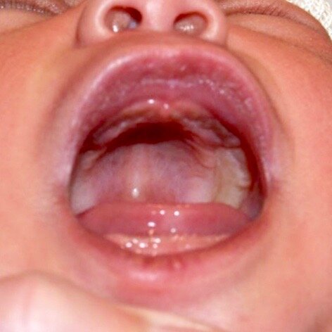 Normal Palate (Intact)