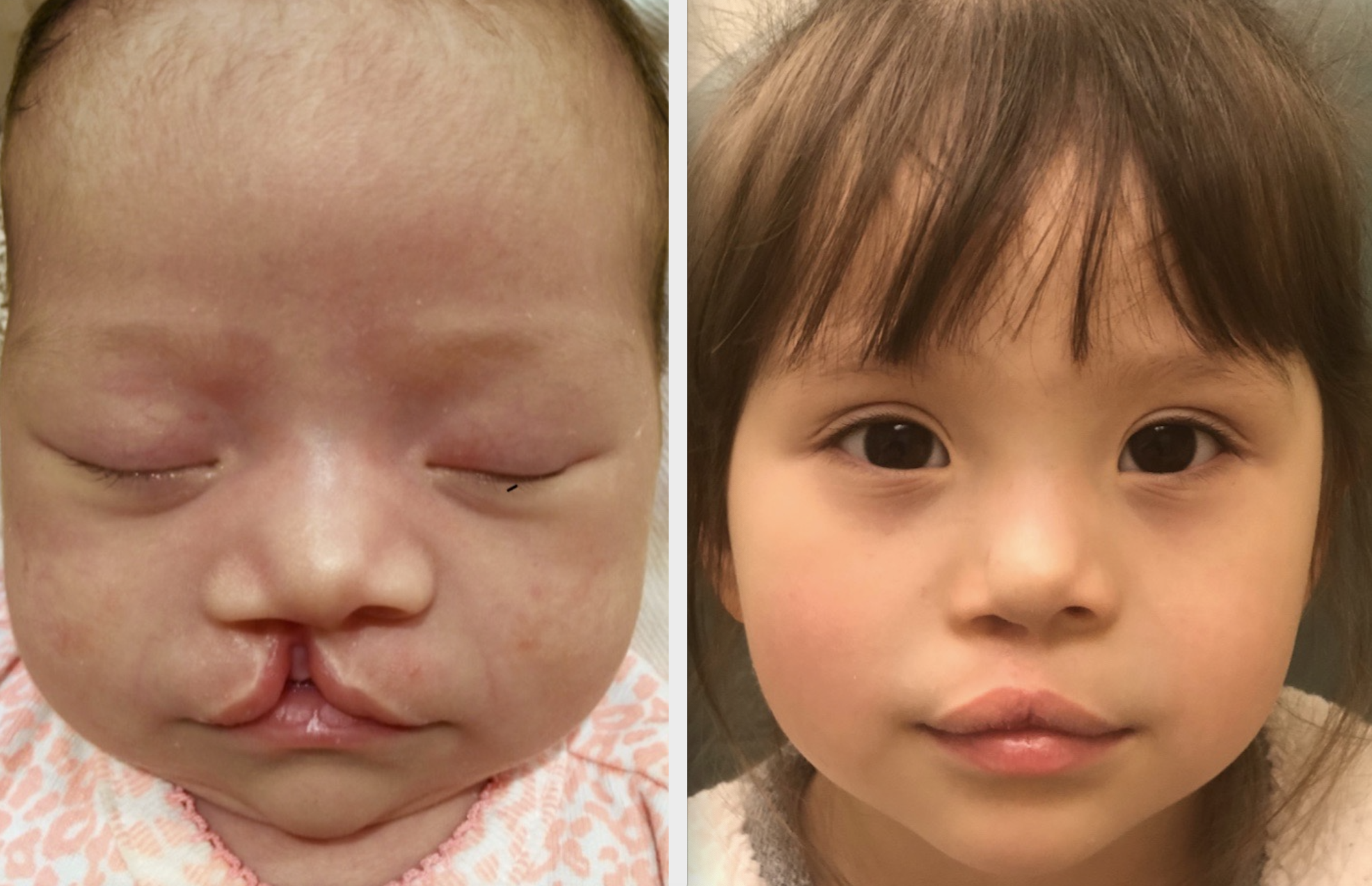 A patient of Dr. Hammoudeh who underwent ECLR at 2 weeks of age, pictured on the right 1 year after surgery.