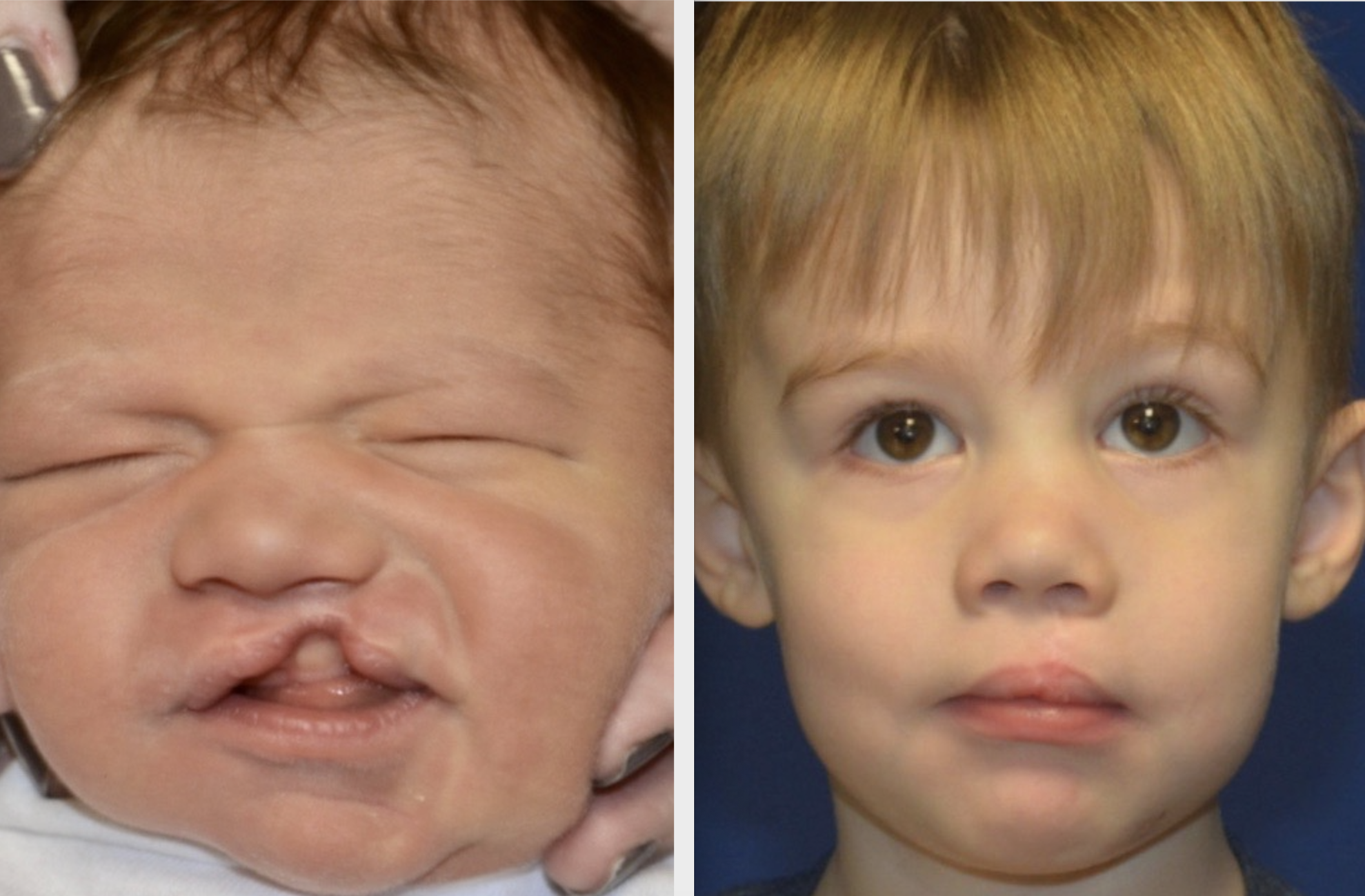 A patient of Dr. Hammoudeh who underwent ECLR at 2 weeks of age, pictured on the right 2 years after surgery.