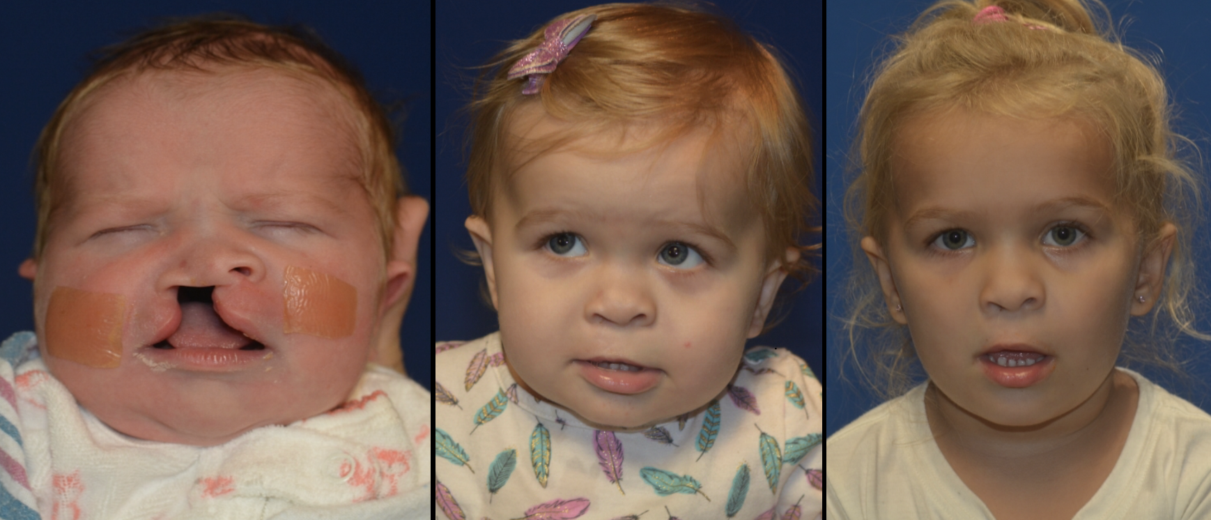 A patient of Dr. Hammoudeh who underwent ECLR at 2 weeks of age, pictured in the middle is 11 months after surgery, and pictured right is 3.5 years after surgery.