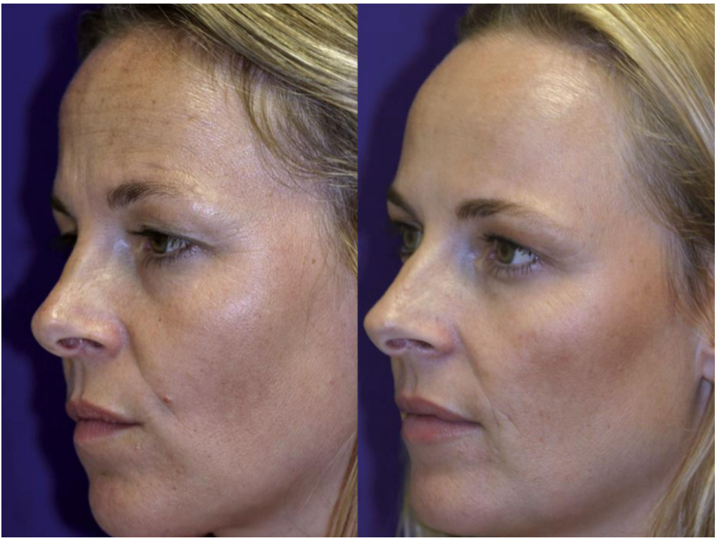 Preventative Botox: A study on Identical twins