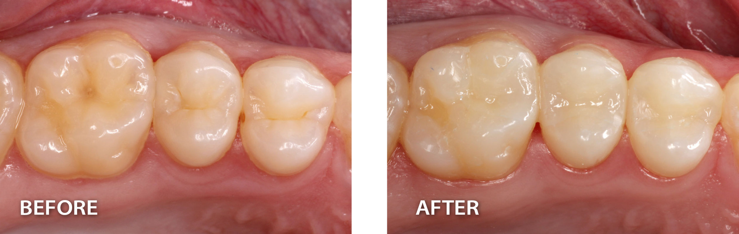  side by side images of teeth before and after direct adhesive dental procedure 