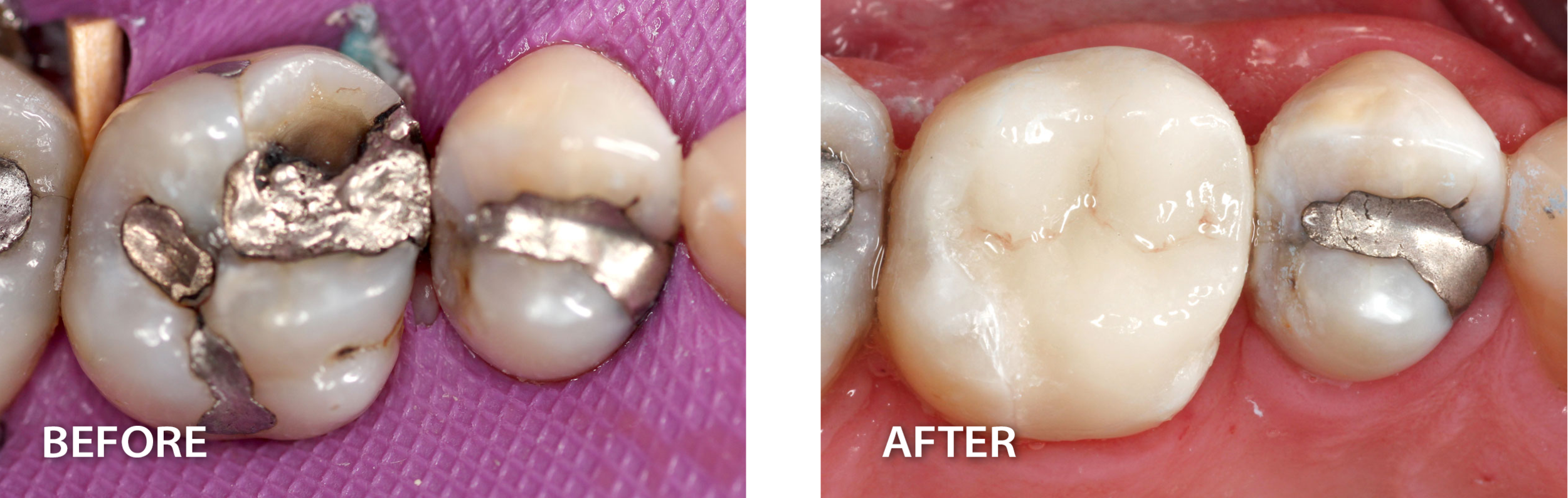  side by side images of teeth with silver fillings before direct adhesive dental procedure beside an after picture of a tooth without the silver fillings.  