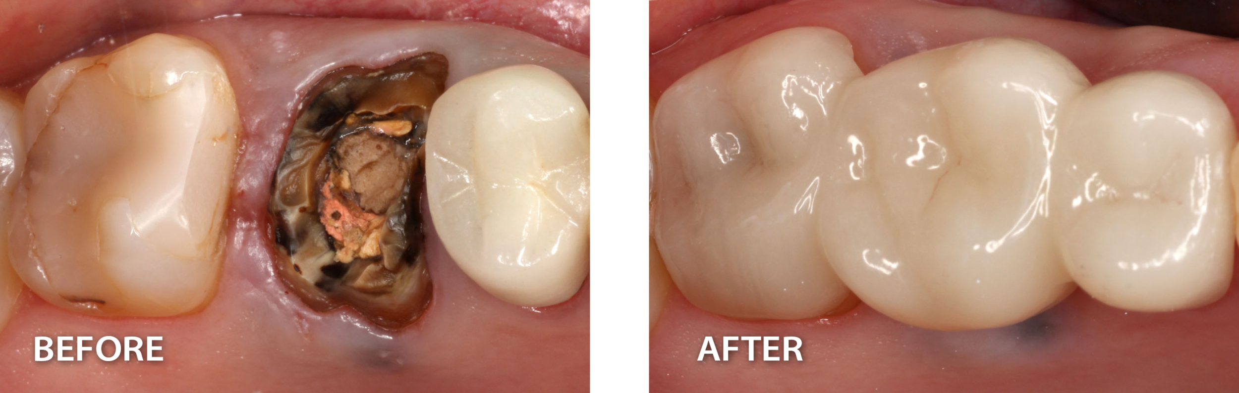  before image of a missing tooth with exposed roots beside an after image of a new tooth replacing the missing one after dental procedure 