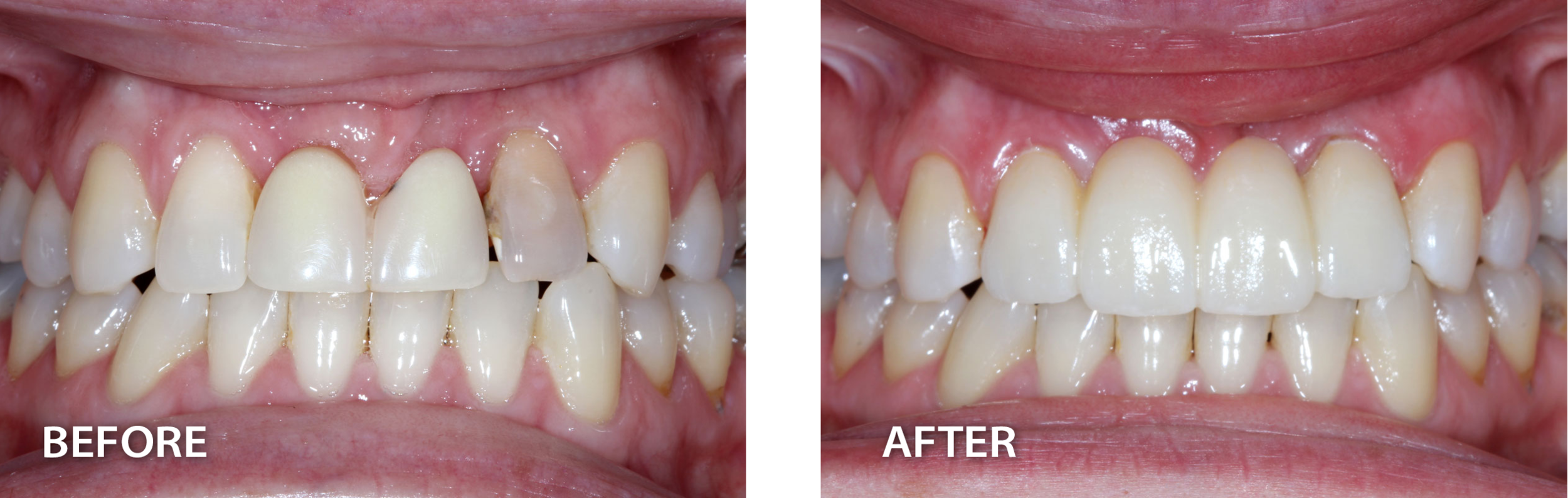  before image of smile with darkened tooth beside image of same smile with the darkened tooth fixed from dental procedure 