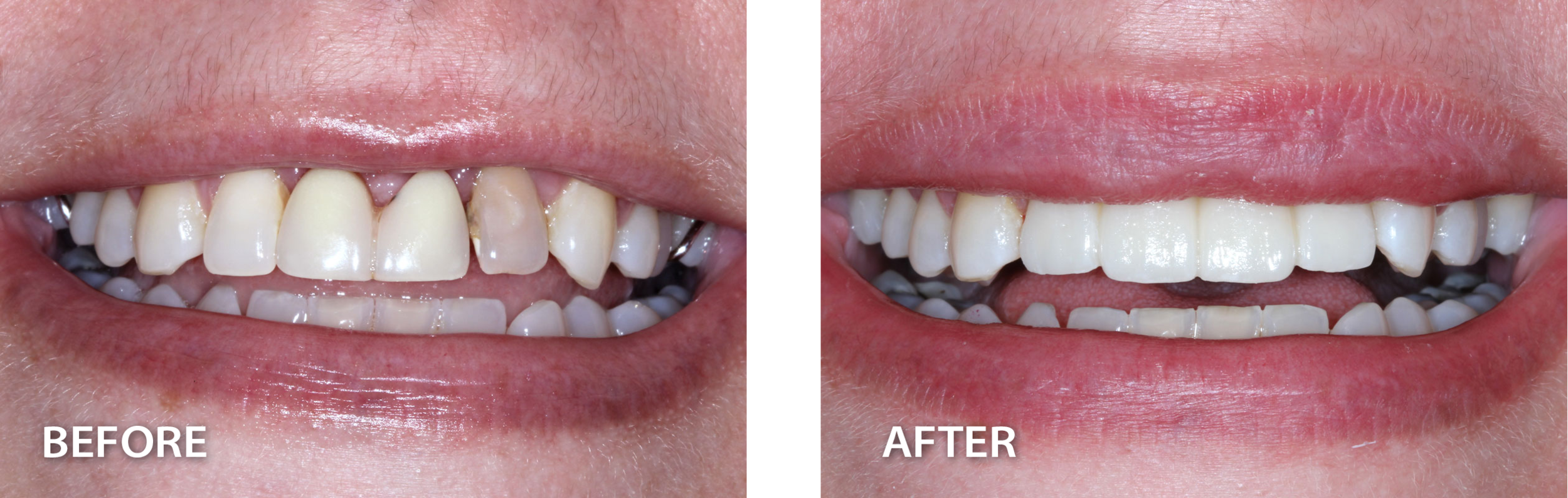  before of smile with darkened, crooked teeth and exposed gums beside after picture of same smile with corrected teeth and gum line from dental procedure 