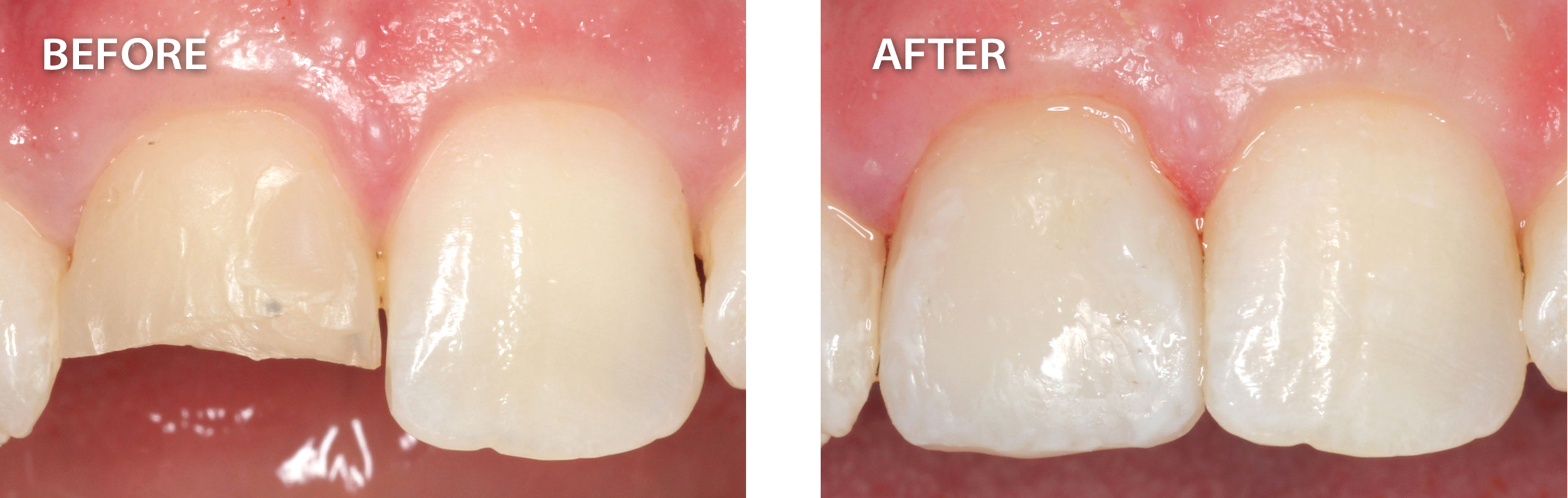  before picture of a broken tooth beside after image of that tooth now fixed from cerec dental procedure 