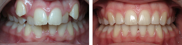 04+Before+&+After+Orthodontics.png