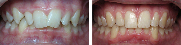 05+Before+&+After+Orthodontics.png