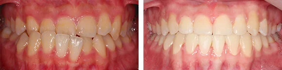 Before+&+After+Orthodontics1.jpg