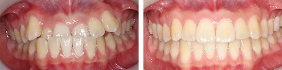 Before+&+After+Orthodontics6.jpg