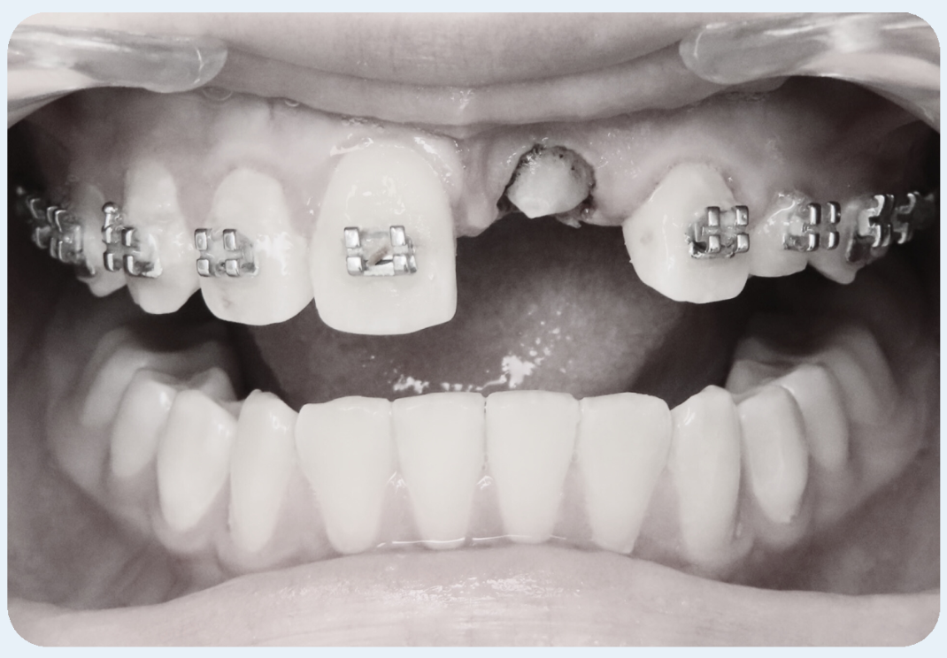 Canine Substitution for a Compromised Central Incisor