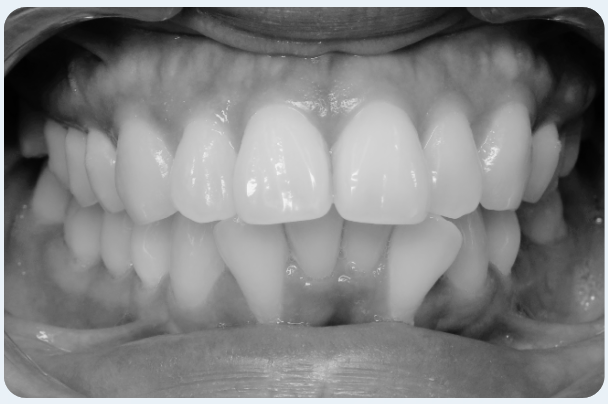 Periodontally-Aware Adult Orthodontics: Adapting Aligners, Fixed Appliances and Extractions to Biological Limits