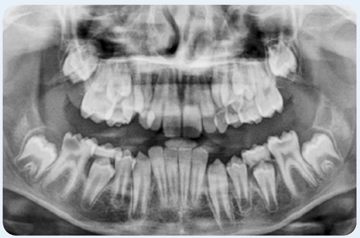 Managing Compromised First Permanent Molars: Timing of Extractions, Eruption Patterns and Orthodontic Intervention