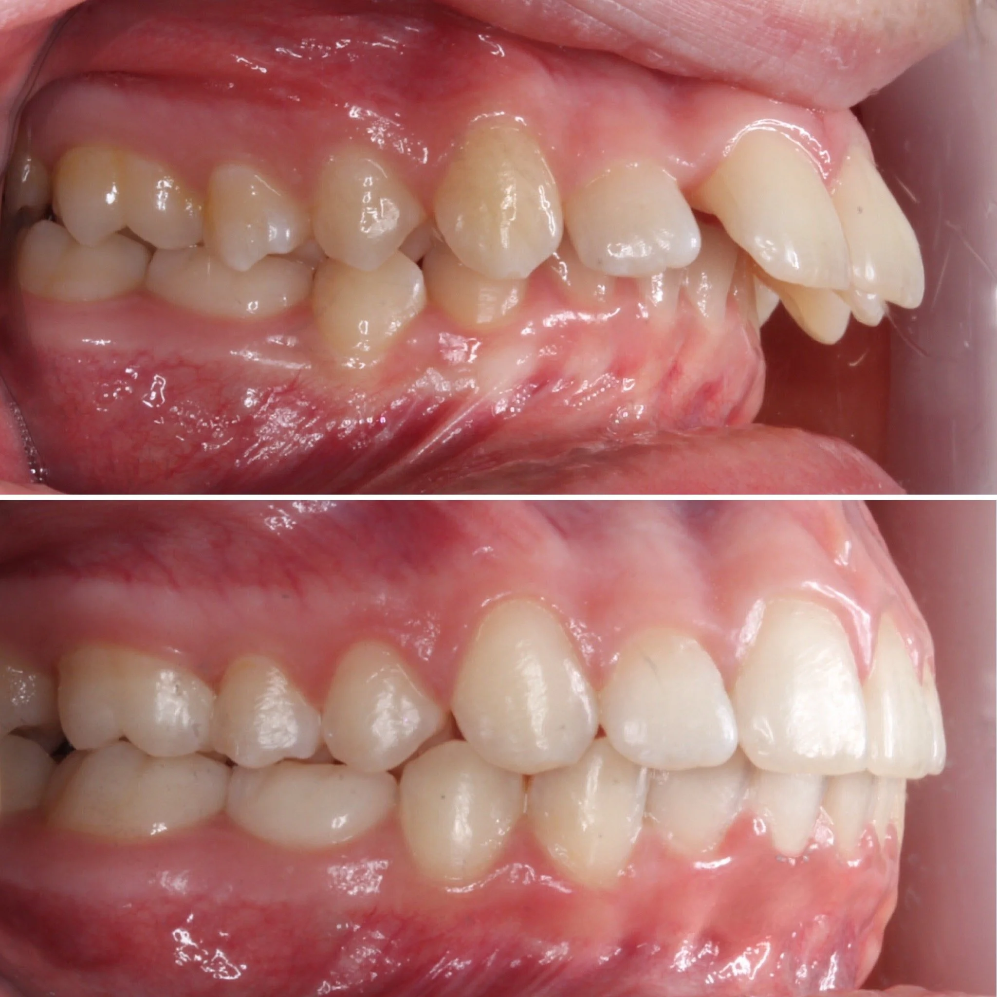 Invisalign-before-after.JPG
