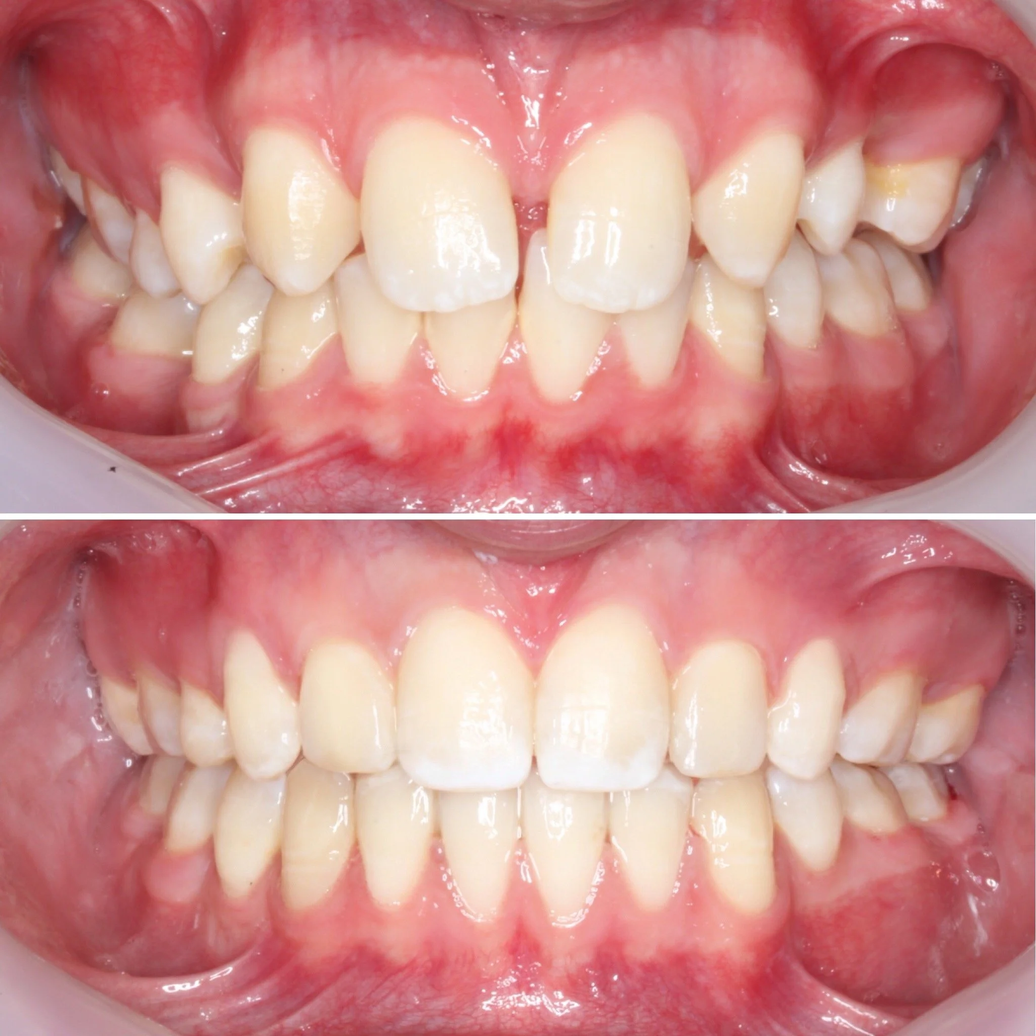 spacing-braces-before-after.JPG