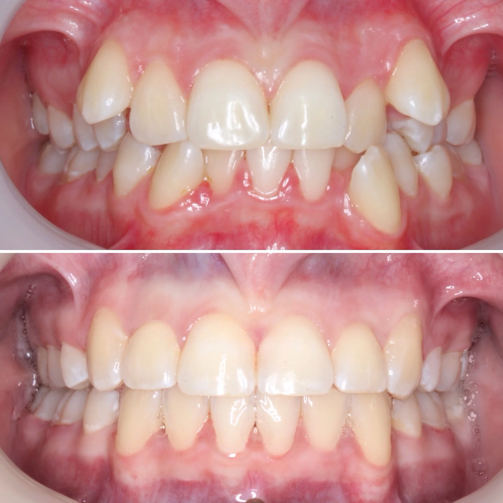 Braces2-before-after.jpeg