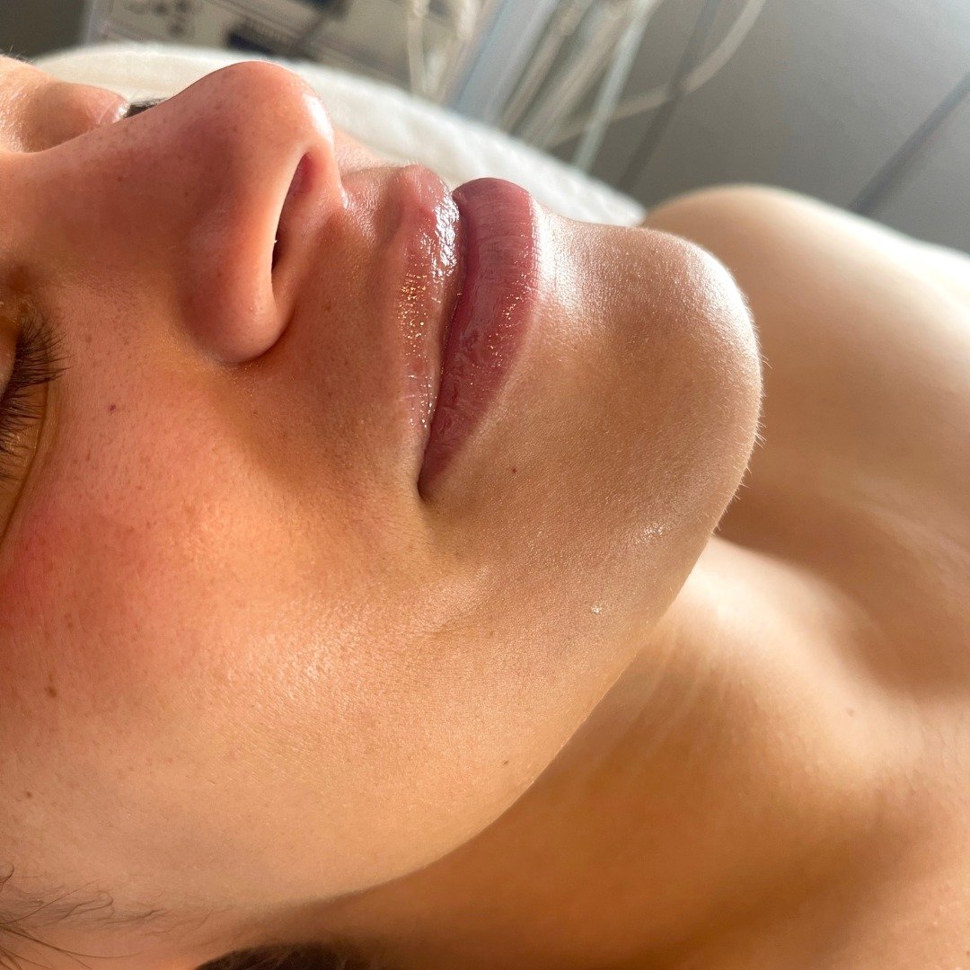 👄Let's revitalize your lips after those long, cold winter months🥶

💁&zwj;♀️Ask your esty about adding a Lip Perk to your next @hydrafacial  treatment!

☎Call now or visit our website to book your next Hydrafacial appointment with @beachsidebeauty_
