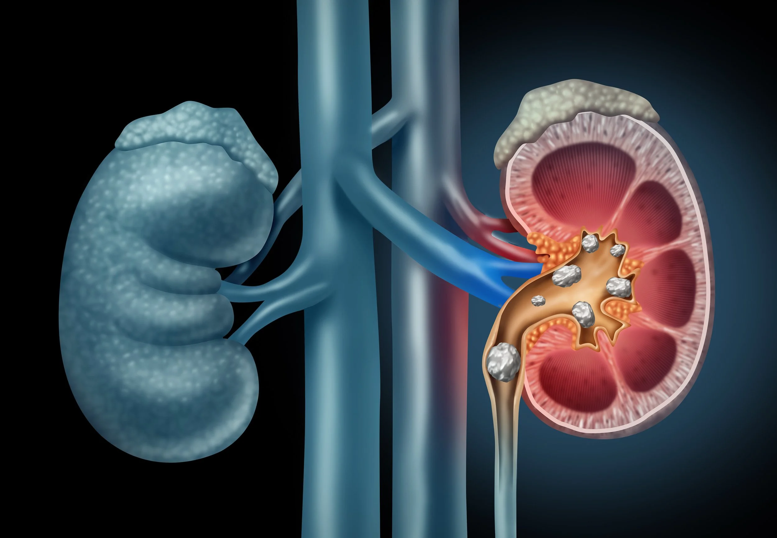 Home Remedy for Kidney Stones with Acoustic Wave Therapy