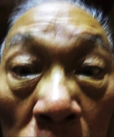 2019 年 6/11 從日本順利返 台。在松山機場接機。看他 已有黃疸,瘦了將近十公斤 精神尚可,他肝功能指數高 得嚇人!