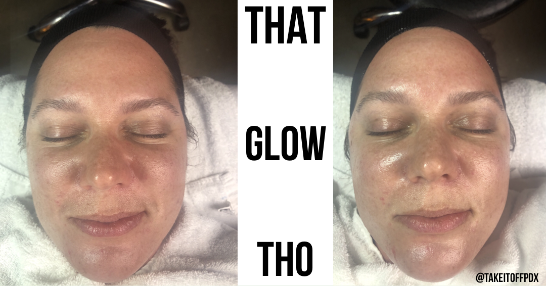 Dermaplane + Enzyme Treatment