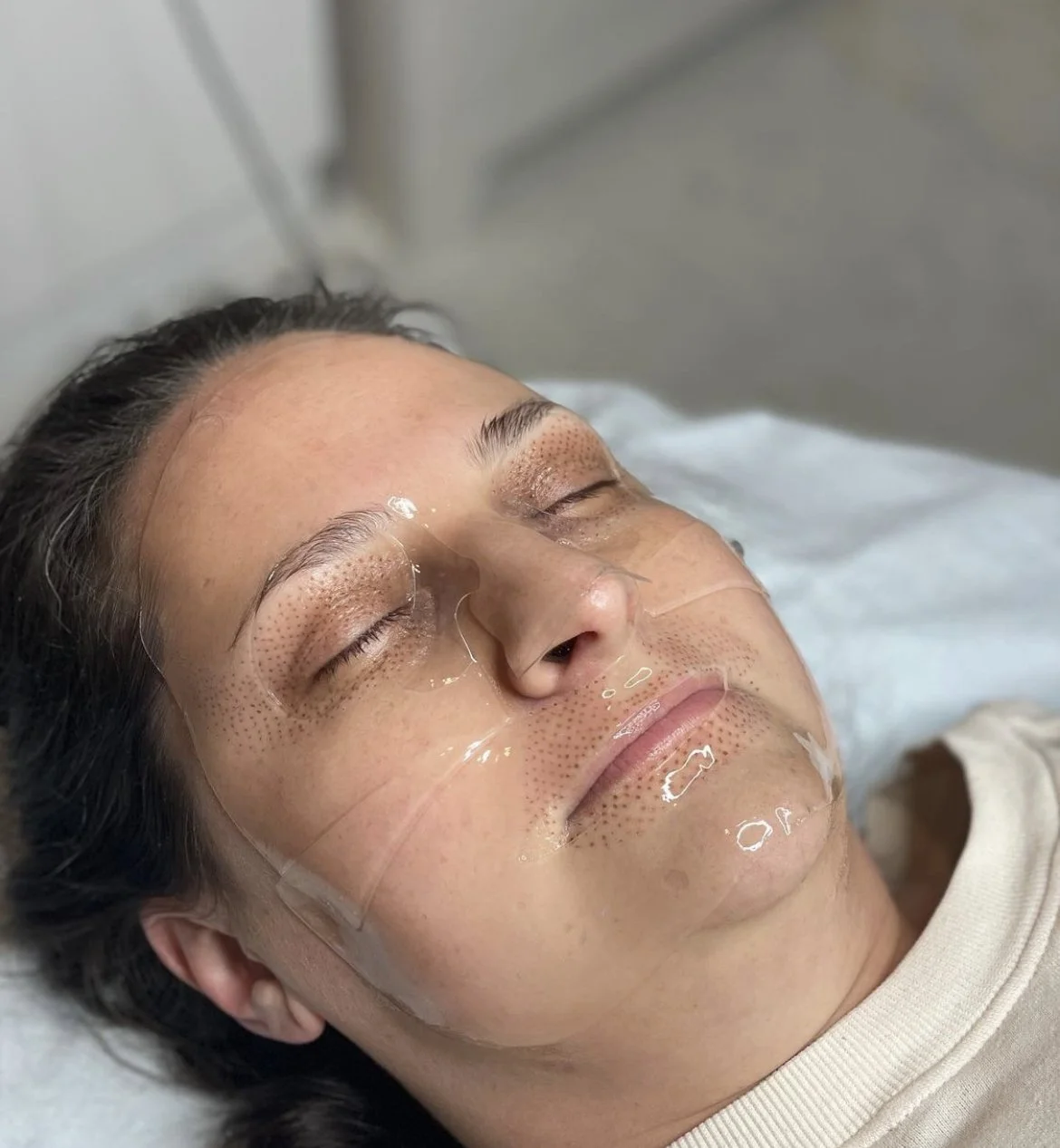 Rock the Dots! Fibroblast Skin Tightening ⚡